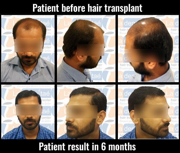 Top 10 Best Hair Transplant in Pune  Hair Clinic in Pune