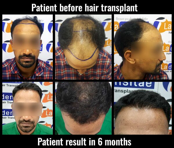 altaf shaif before after results hair transplant in pune