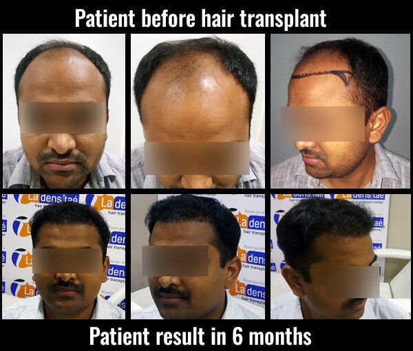 Top Hair Transplant Clinics in Ernakulam  Best Hair Transplant Doctors   Justdial