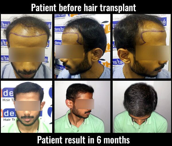 Hair Graft Calculator  Hair Transplant Cost  Medispa India