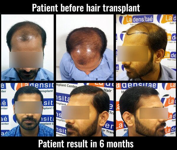 prem before after results hair transplant pune
