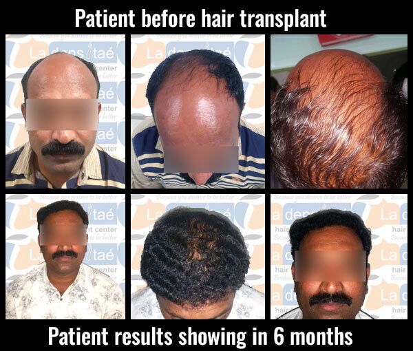 rishikeshmore-after-results-hair transplant in pune