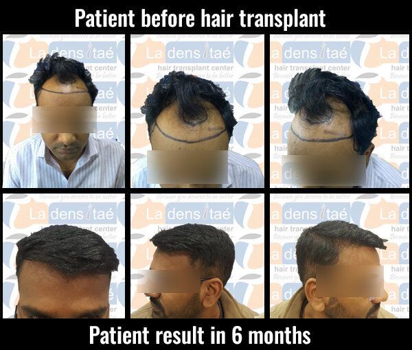sambhaji-ladensitae-results hair transplant pune