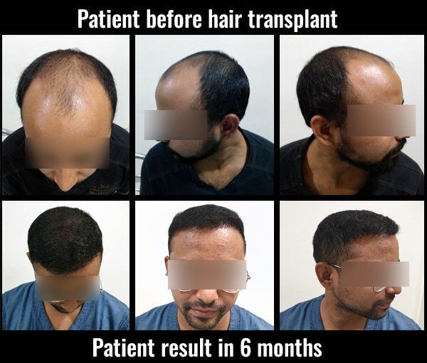 saurabh before after results hair transplant pune