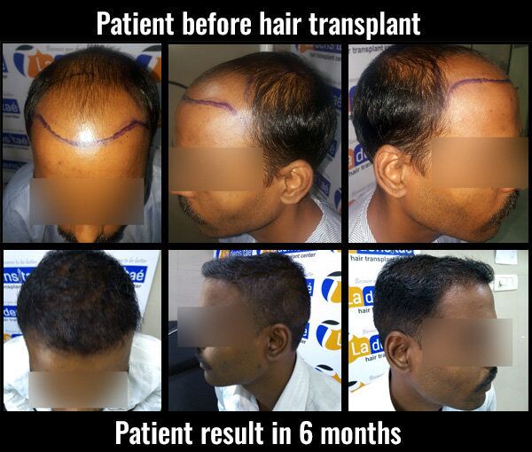 somnath-before-after-results-hair transplant pune
