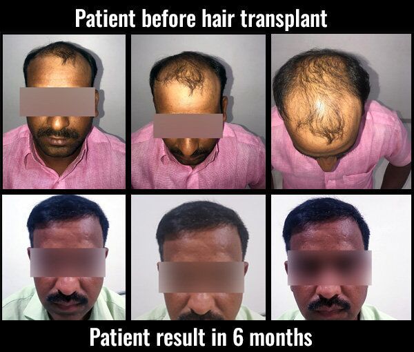 somnath-before-after-results-hair- transplant pune