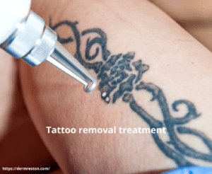 Permanent Tattoo Removal In Bangalore  Laser Tattoo Removal Clinic