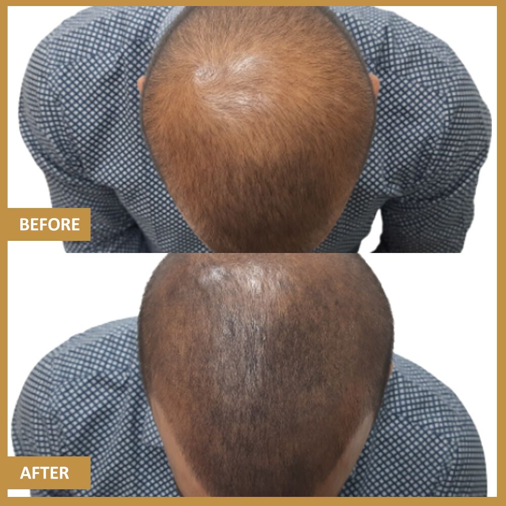 Laser Scalp Micropigmentation Removal  Munster