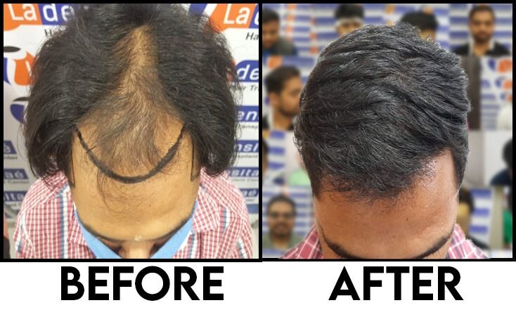 La densitae hair transplant online consultation by saurabh image 2