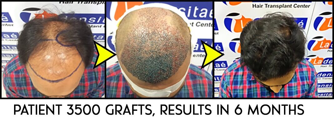 Hair transplant patient pic 1