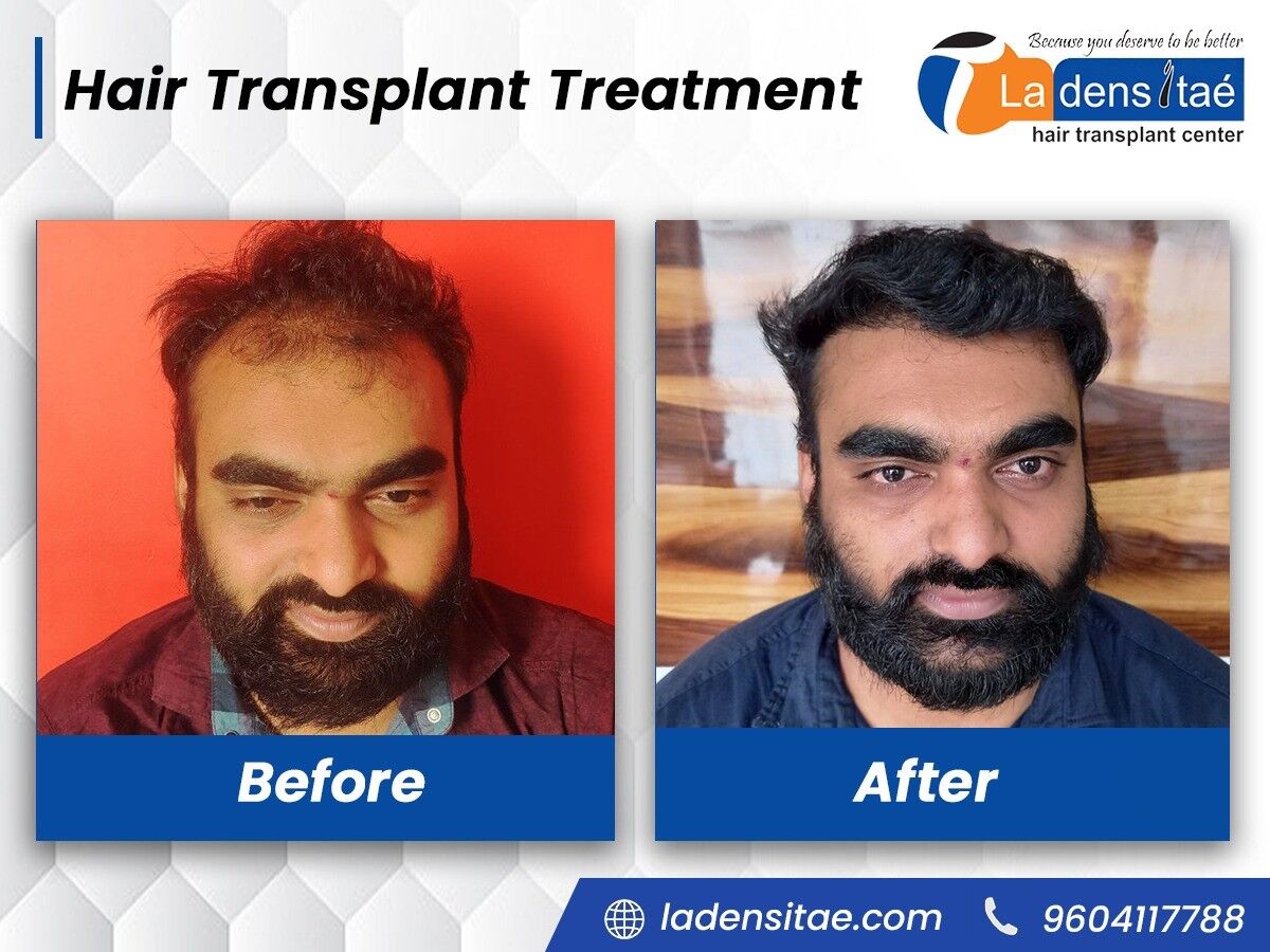 Hair loss Treatment in kolhapur 12