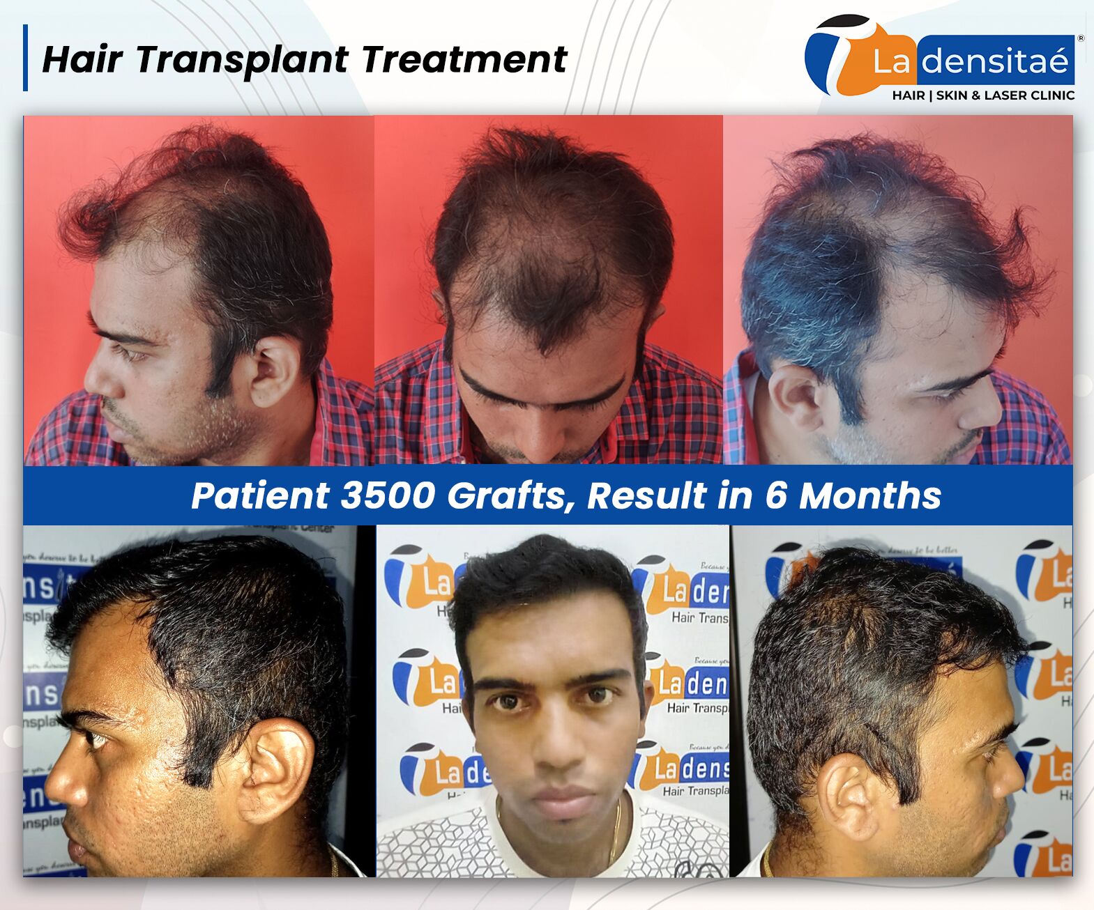 eyebrow growth treatment