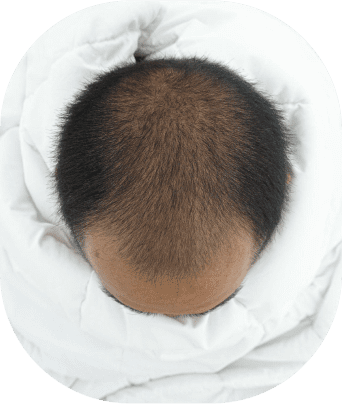 Go Bald to Bold in ladensitae