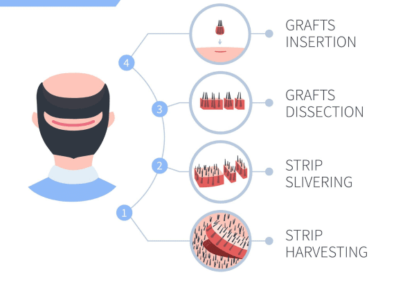 Baldness Treatment in la densitae