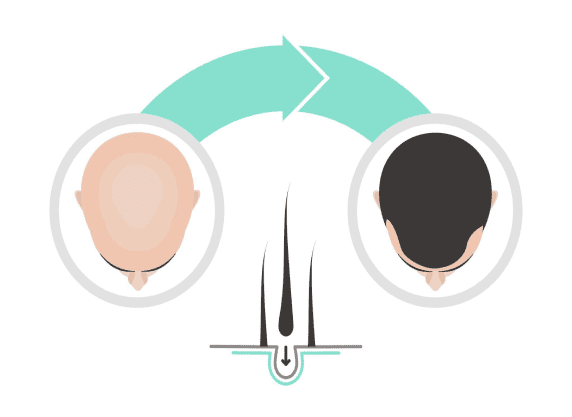 Baldness Treatment in la densitae